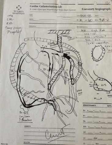 Coronary angiogram report illustrating heart anatomy and blood vessel assessments, used for evaluating cardiovascular health.